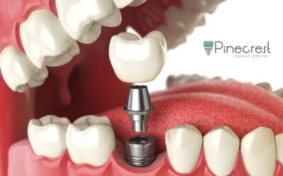 Dental Implants in Pinecrest, FL